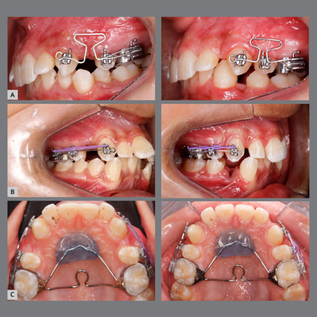 Comparative evaluation of the efficiency of segmental maxillary canine retraction using Burstone T-loops versus elastomeric chains: a split-mouth randomized clinical trial