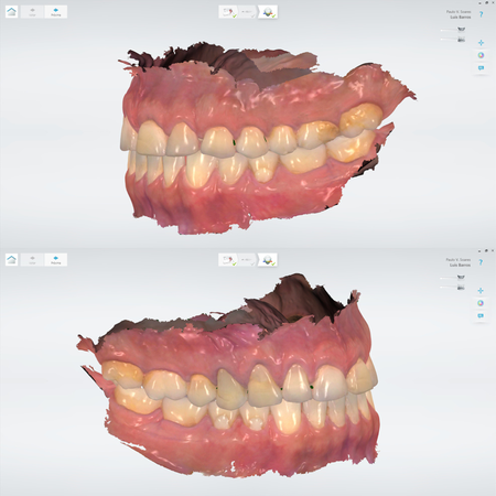 Utilização de scanner intraoral como método complementar para diagnóstico e acompanhamento de lesões não cariosas: série de casos clínicos