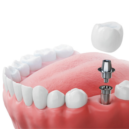 Treatment of peri-implantitis: a narrative review of current strategies