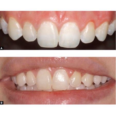 Rehabilitation of Dental Fluorosis: A Clinical Case Report
