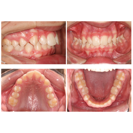 Mesialization of molars with mini-implants as an alternative approach for treating missing mandibular second premolars: case report