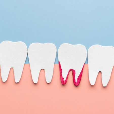 Self-reported questions for screening severe periodontitis: a cross-sectional study
