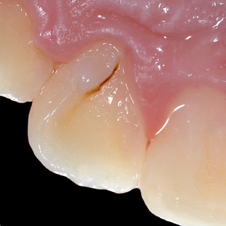 The five ‘truly’ cervical lesions or diseases. Part 1: The palatogengival groove