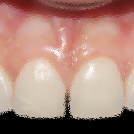 Comparison of melanoplasty surgery performed with laser and scalpel: a split-mouth case report