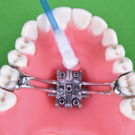 Orientações de higiene para os aparelhos expansores de maxila dentossuportados, dentomucossuportados e dento-osseossuportados