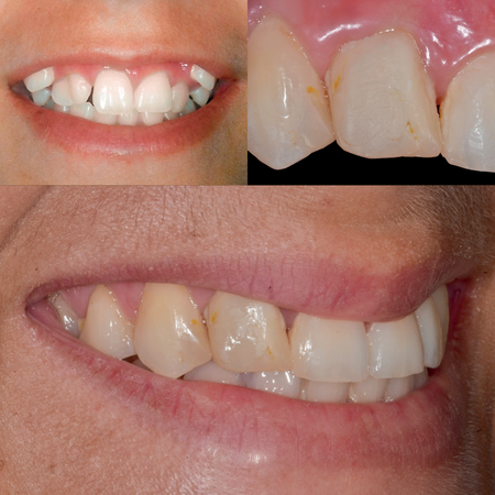 Abordagem periodontal e restauradora para tratamento de dente duplo em zona estética: um relato de caso