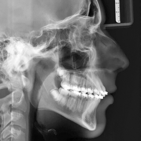Tratamento da sobremordida com Platô Júnior e Sistema Autoligado Dual Bidimensional: relato de caso clínico com acompanhamento de três anos