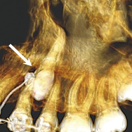 The ten outcomes of an unerupted tooth