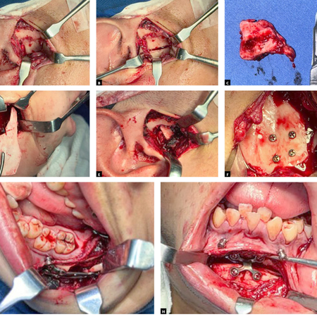 Ankylosis treatment with rotation of the coronoid process: case report