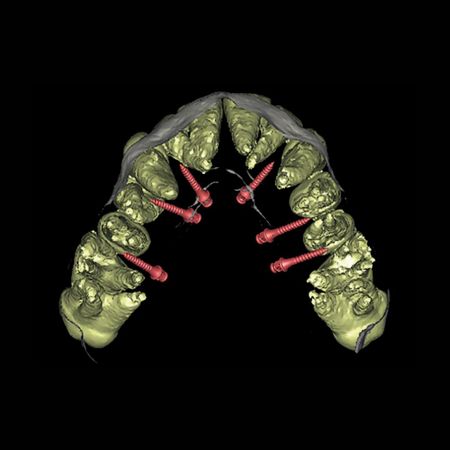 C-expander guide – safety protocol for installing the MARPE C-expander: a clinical case report