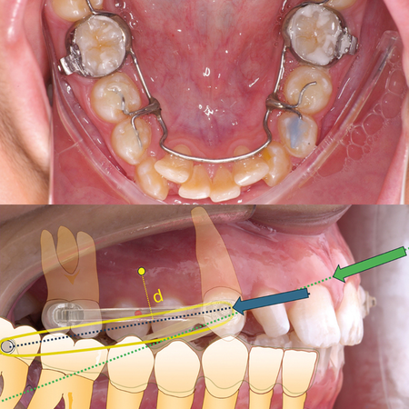 Variations in the application of force in  the Carriere type distalizer. Part II:  Effect on lower molars