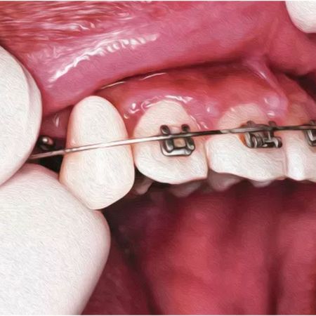 Adaptación dental temporal en aparato fijo