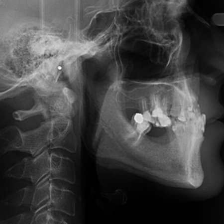 Treatment of a case with multiple missing teeth and bone resorption using aligners: Case report