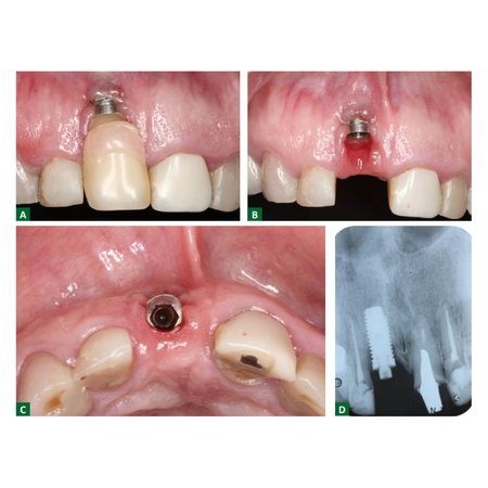 Prosthetic-surgical approach to treat severe peri-implant soft tissue dehiscence in the aesthetic zone: a case report