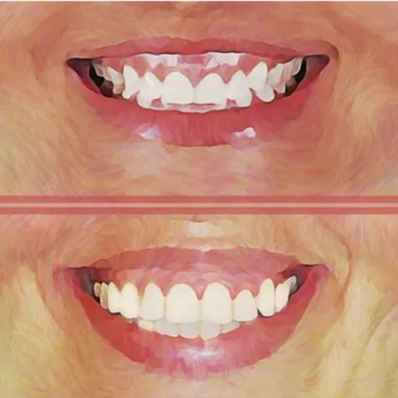 Orthodontic correction of gingival smile and maxillary incisor positioning: synergy or challenge