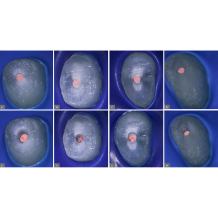 Effect of ultrasonic root-end resection and root-end preparation on dentinal microcrack formation