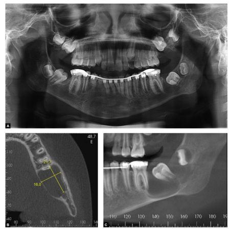 Pediatric Gorlin-Goltz syndrome: long-term follow-up and adaptive management