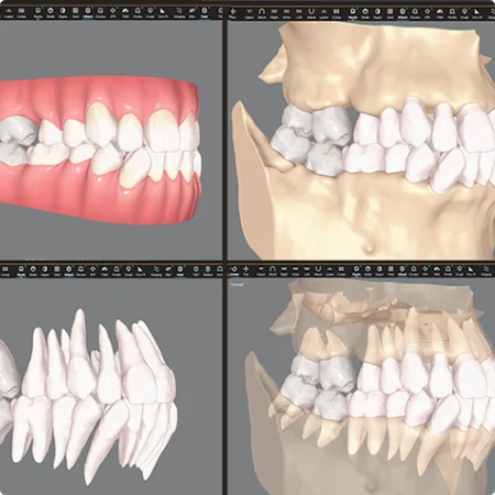 A pilot study comparing virtual treatment setups among clear aligner companies