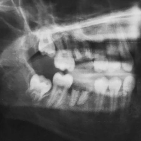 Tooth transplantation in rehabilitation of low-income youth: two case reports