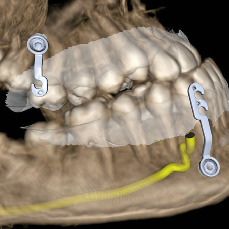 Ortho Stable: conceptual evolution of skeletal anchoring in Orthodontics