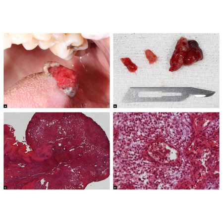 Granuloma piogênico na língua: relato de caso clínico cirúrgico