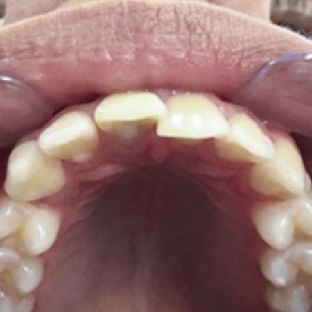 Tratamento endodôntico não cirúrgico de um dente associado a uma grande lesão periapical: relato de caso com 24 meses de acompanhamento