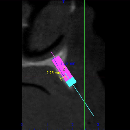 Tomographic analysis of edentulous maxillae for All-on-4® planning