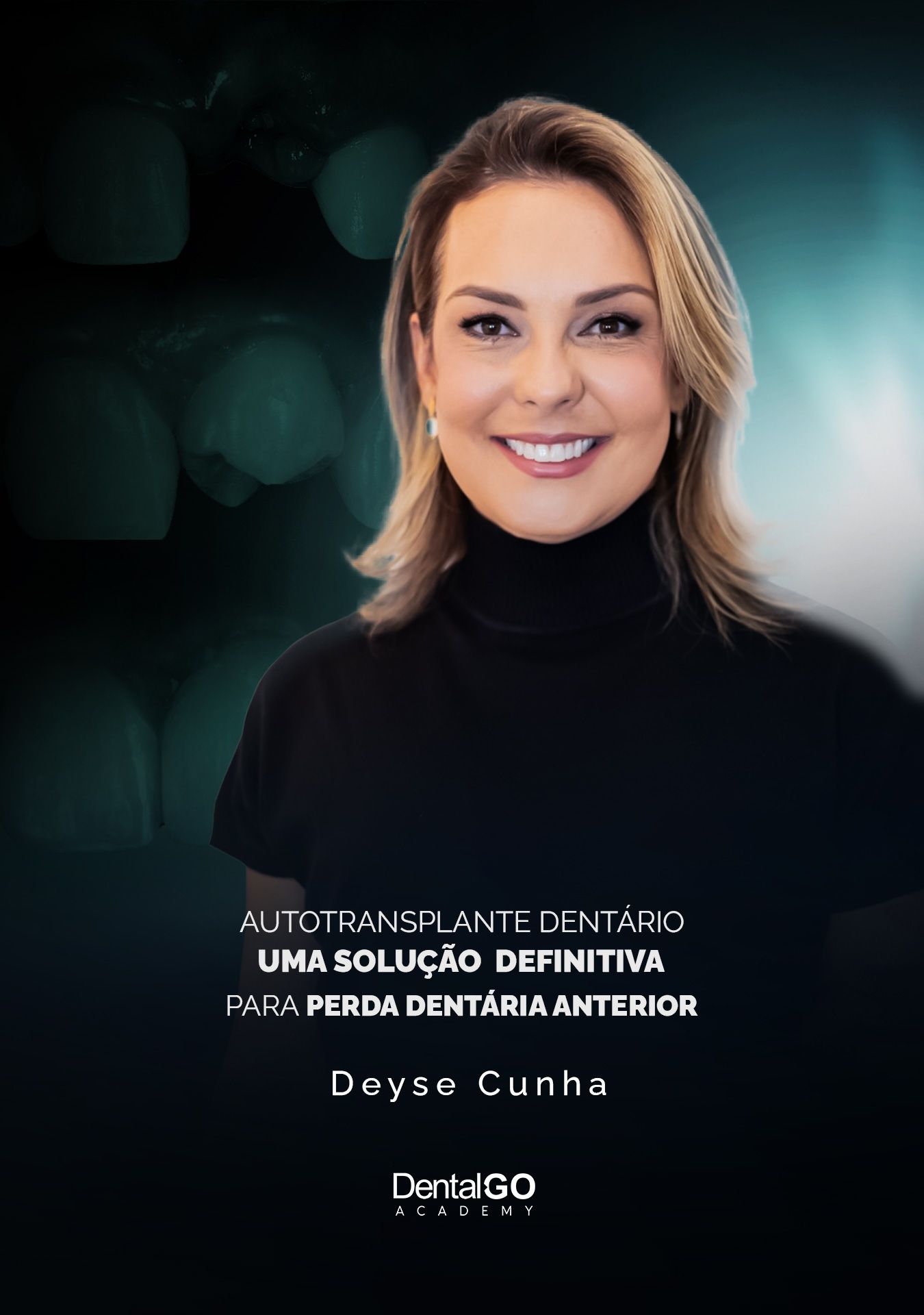 Autotransplante Dentário uma solução Definitiva para perda dentária anterior