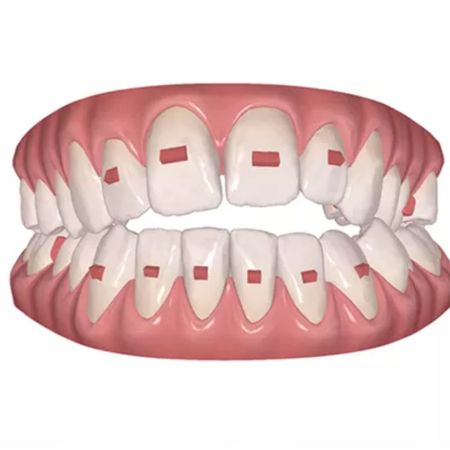Anterior open bite correction with efficient attachment protocol in clear aligner therapy: a case report