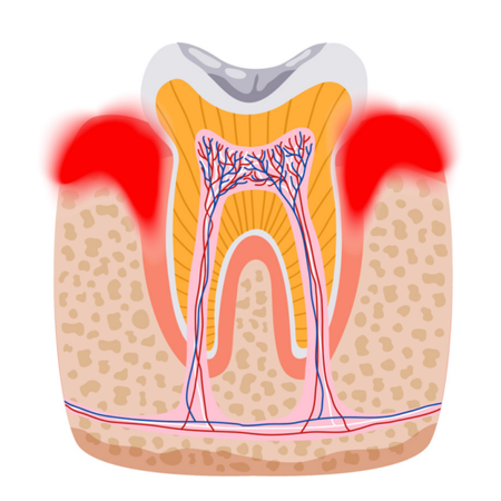 Photodynamic therapy of necrotizing gingivitis in Chikungunya-positive pediatric patient: case report