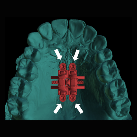 Miniscrew-assisted rapid palatal expansion (MARPE): Factors influencing planning