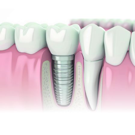 Periodontal treatment and rehabilitation in a patient with peripheral ossifying fibroma in an aesthetic area: case report with five-year follow-up