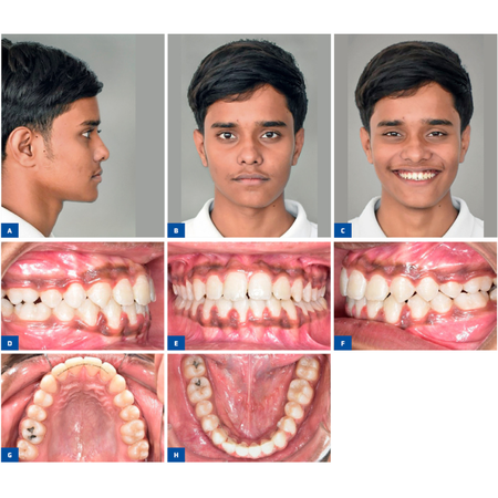 Camuflagem de má oclusão de Classe III esquelética com assimetria e mordida cruzada unilateral utilizando desprogramação oclusal: relato de caso