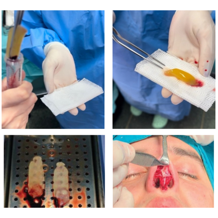 APPLICATIONS OF THE USE OF PLATELET-RICH FIBRIN (PRF) IN RHINOPLASTY IN PATIENTS WITH THIN SKIN