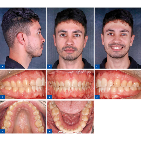 Orthodontic-surgical treatment of a Pattern II hyperdivergent patient