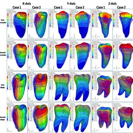 Comparative evaluation of displacement and stress distribution pattern during mandibular arch distalization with extra and inter-radicular mini-implants- a three-dimensional finite element study
