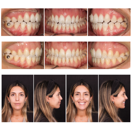 Invisalign para tratamento de mordida aberta anterior