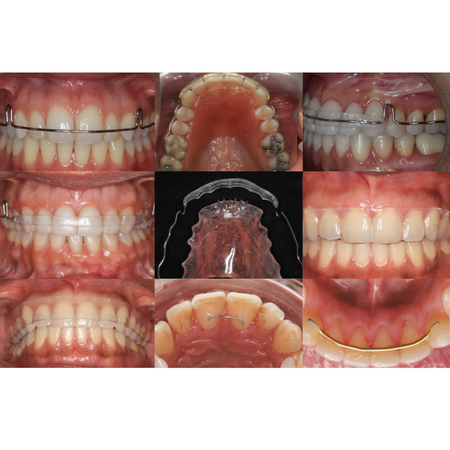 Orthodontic retainers: are they all the same?