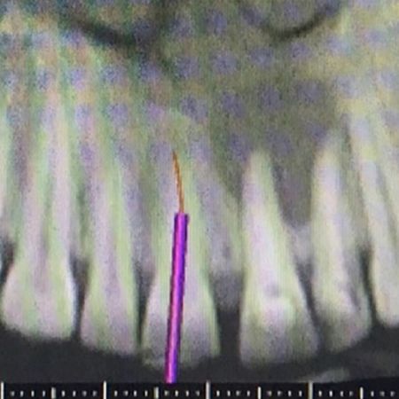 Treatment with guided endodontic access in teeth with pulp canal obliteration: case report