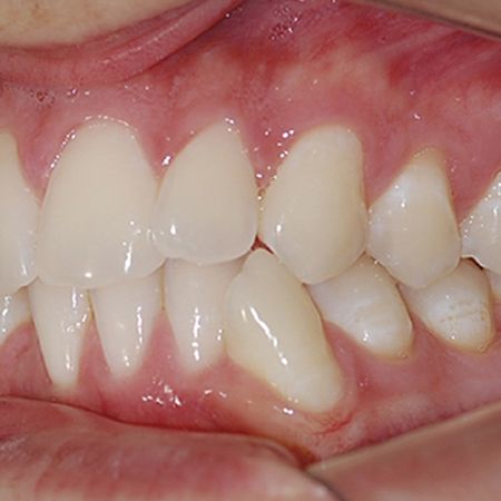 Distração osteogênica na sínfise mandibular como alternativa para tratamento de discrepâncias dentoalveolares em pacientes adultos