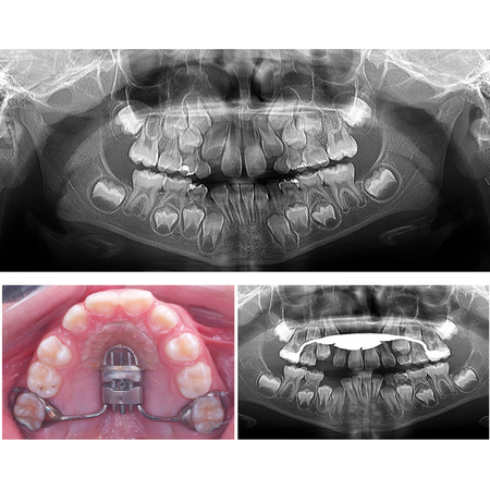 Disjunção palatina anteroposterior e a pré-maxila