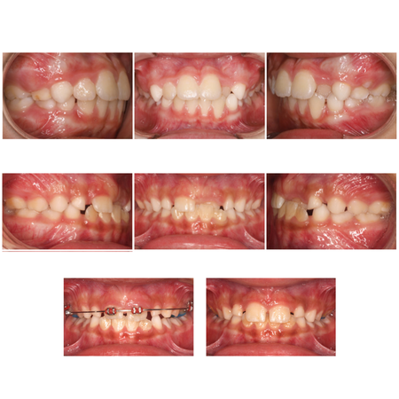 Técnicas 2x4 y 2x2 en la corrección de la mordida cruzada anterior dental