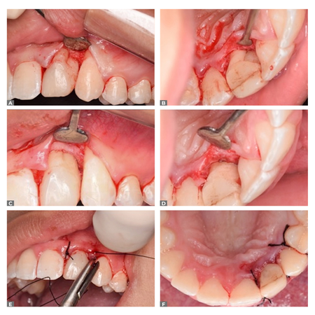 Endodontic-periodontal treatment of a maxillary lateral incisor with dental fusion and root grooves: case report