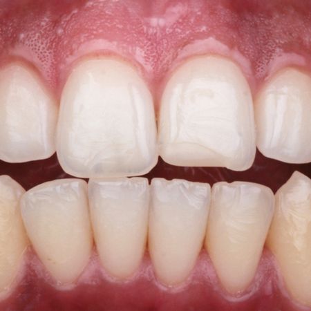 Reanatomização minimamente invasiva dos dentes anterossuperiores com resina composta: relato de caso clínico