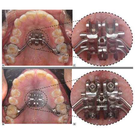 MISMARPE protocol: minimally invasive surgical and miniscrew-assisted rapid palatal expansion