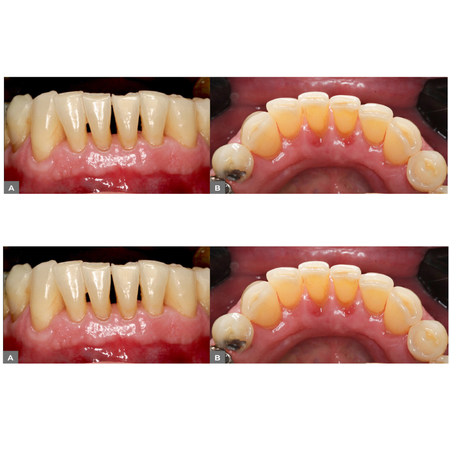 Clinical and diagnostic considerations of an inflammatory external resorption associated with periodontal lesion: case report