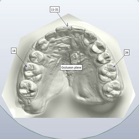 Fechamento de espaço de agenesia de incisivo lateral superior em pacientes com fissura labiopalatina transforame unilateral: uma avaliação de modelos digitais