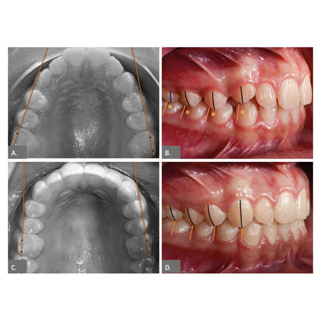 Toe-in bend as an alternative way to correct Class II molar relationship