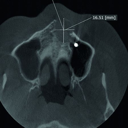 Guided bone regeneration after enucleation of extensive cystic lesion in the maxilla: case report