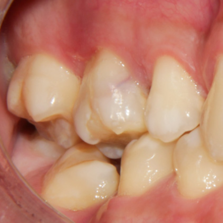Treatment of pyogenic granuloma with high-power diode laser: a case report